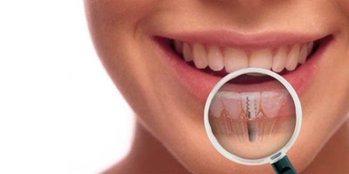 Dlaczego warto założyć implanty stomatologiczne?